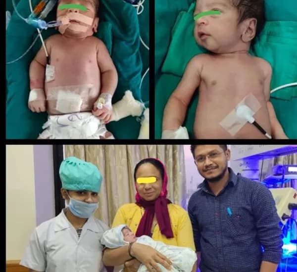 newborn baby with generalized edema and respiratory distress