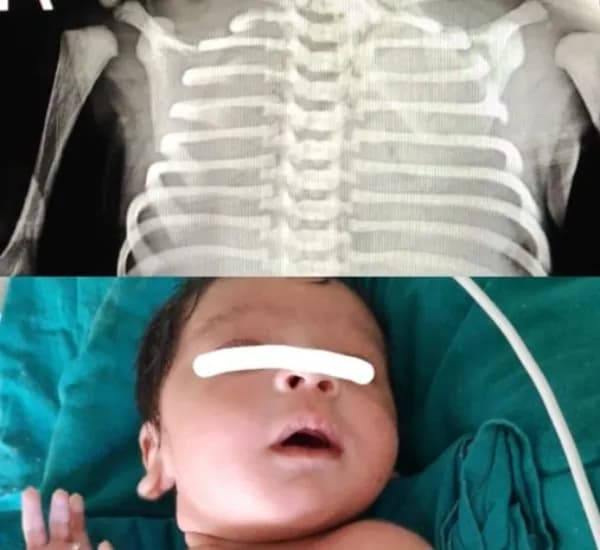 baby with severe meconium aspiration syndrome